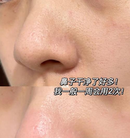 如何有效去除学生鼻子黑头（学生鼻子黑头的成因）