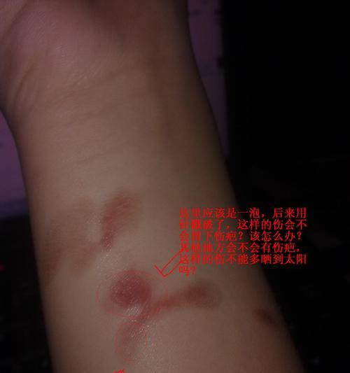 手被烫伤后如何处理水泡(有效方法帮助你缓解烫伤引起的不适)