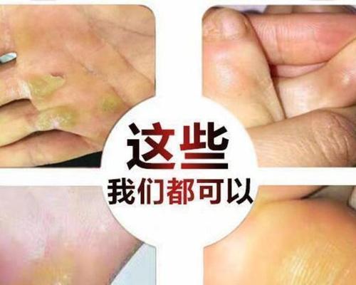 脚鸡眼怎么治最有效？最佳治疗方法是什么？