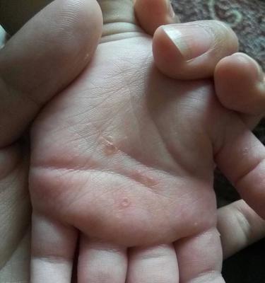 长透明小水泡是什么原因引起的?如何预防和处理?