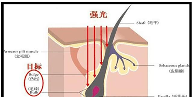 最常用的脱毛方法有哪些?如何选择适合自己的脱毛方式?